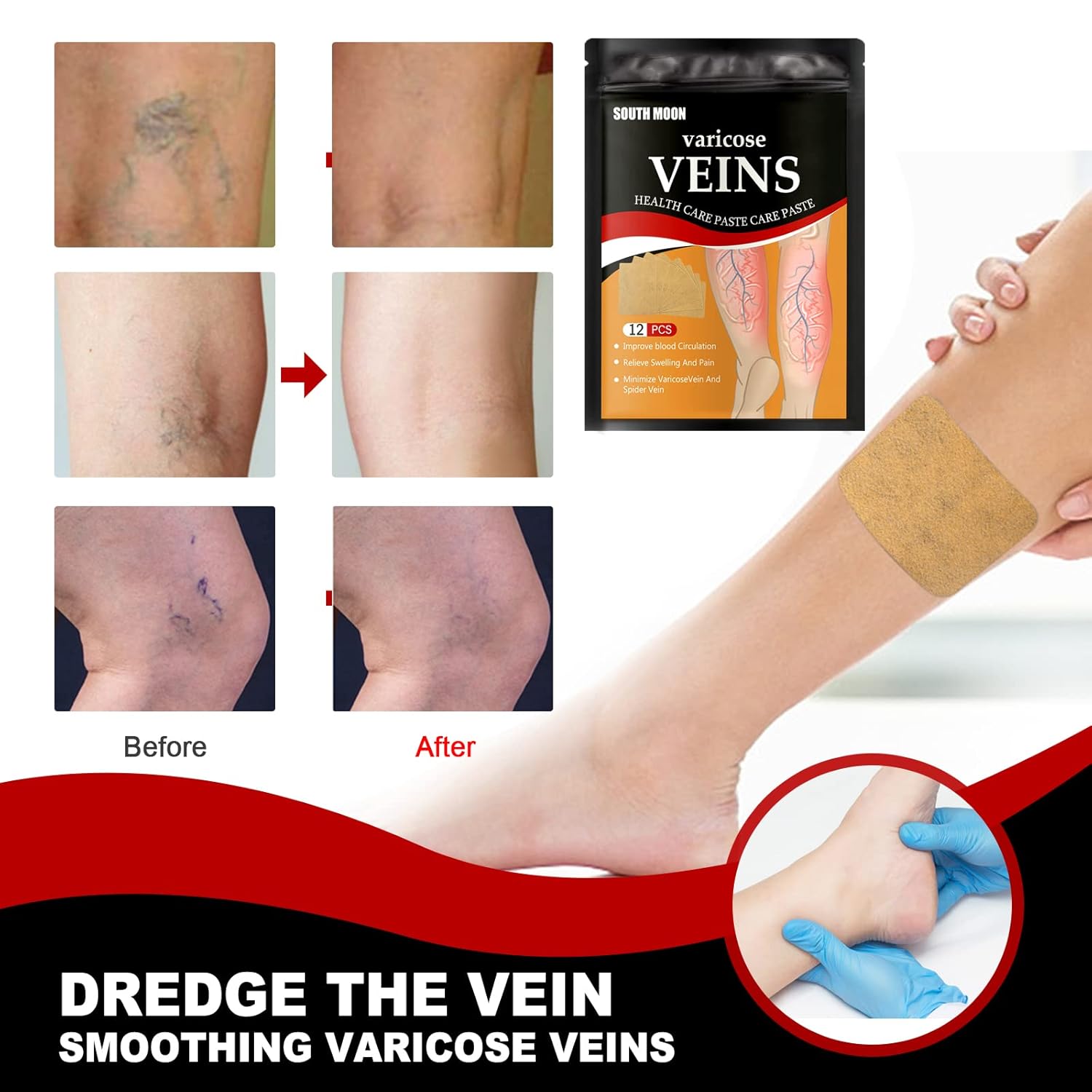 Parches para varices